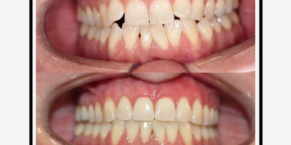Zähne, vor (schief) und nach (gerade) der Behandlung - Alzey