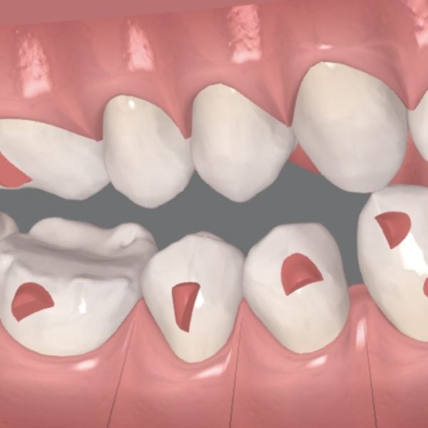 Grafik zeigt Attachments auf den Zähnen