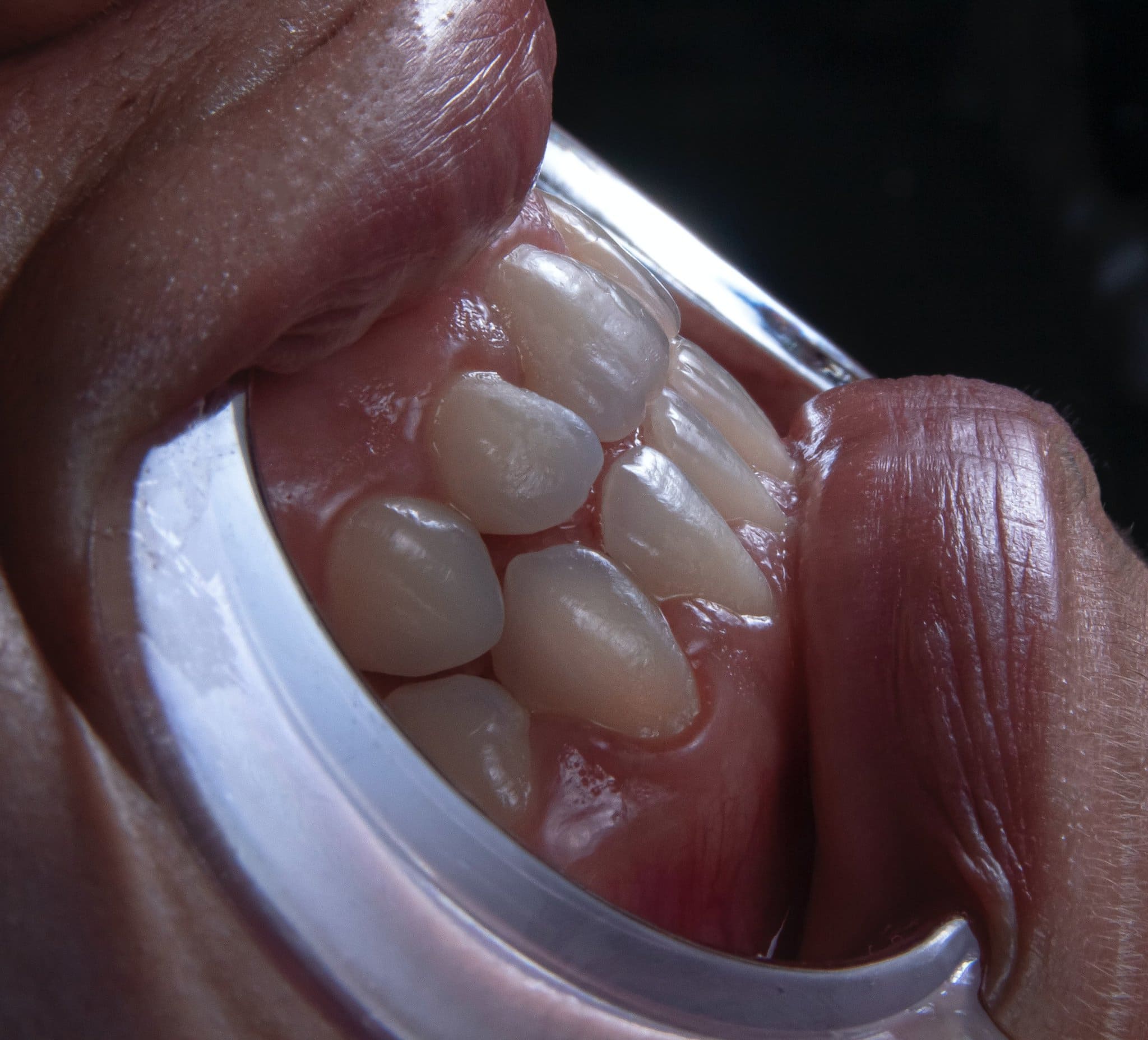 Perfekte Zähne bekommen durch Professionelle Zahnreinigung