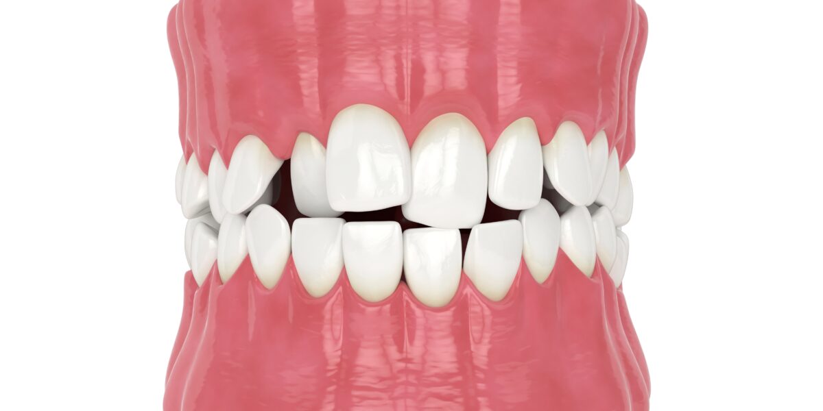 Zahnfehlstellung - metallfreie Aligner