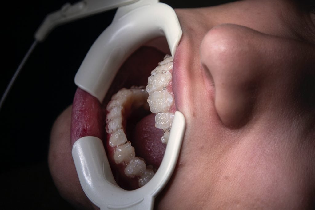 In Office Zahn Bleaching - Weißmacher Zähne