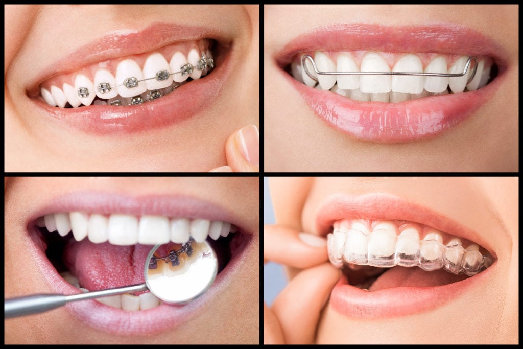 Zusammengesetztes Bild mit 4 verschiedene Arten Zahnspange: klassische Feste, herausnehmbare und linguale Zahnspangen und Aligner