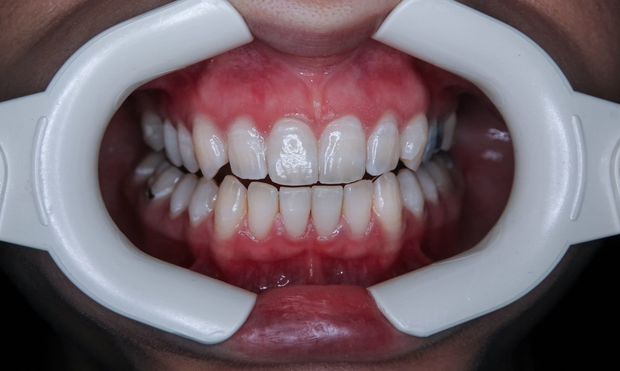 Bleaching als ästhetische Zahnmedizin