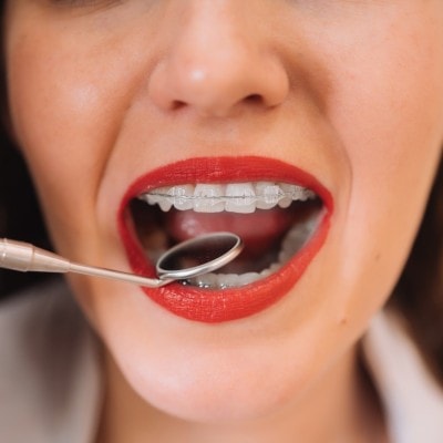 Wie hoch sind die Kosten für die feste Zahnspange?