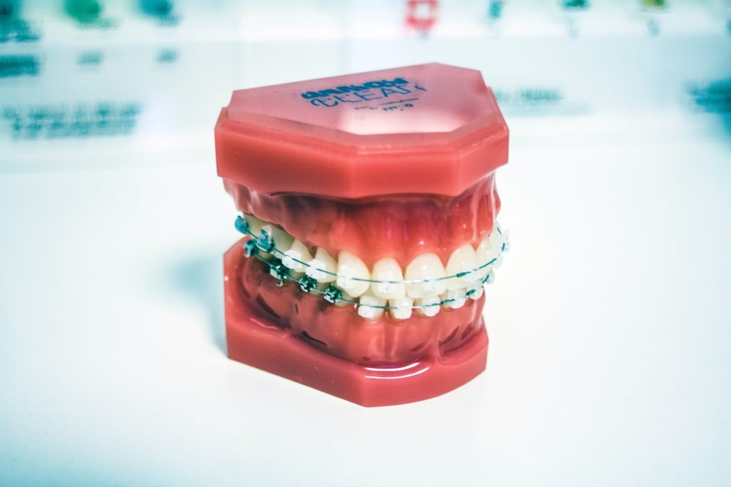 Kosten Vergleich metallische und durchsichtige feste Zahnspange