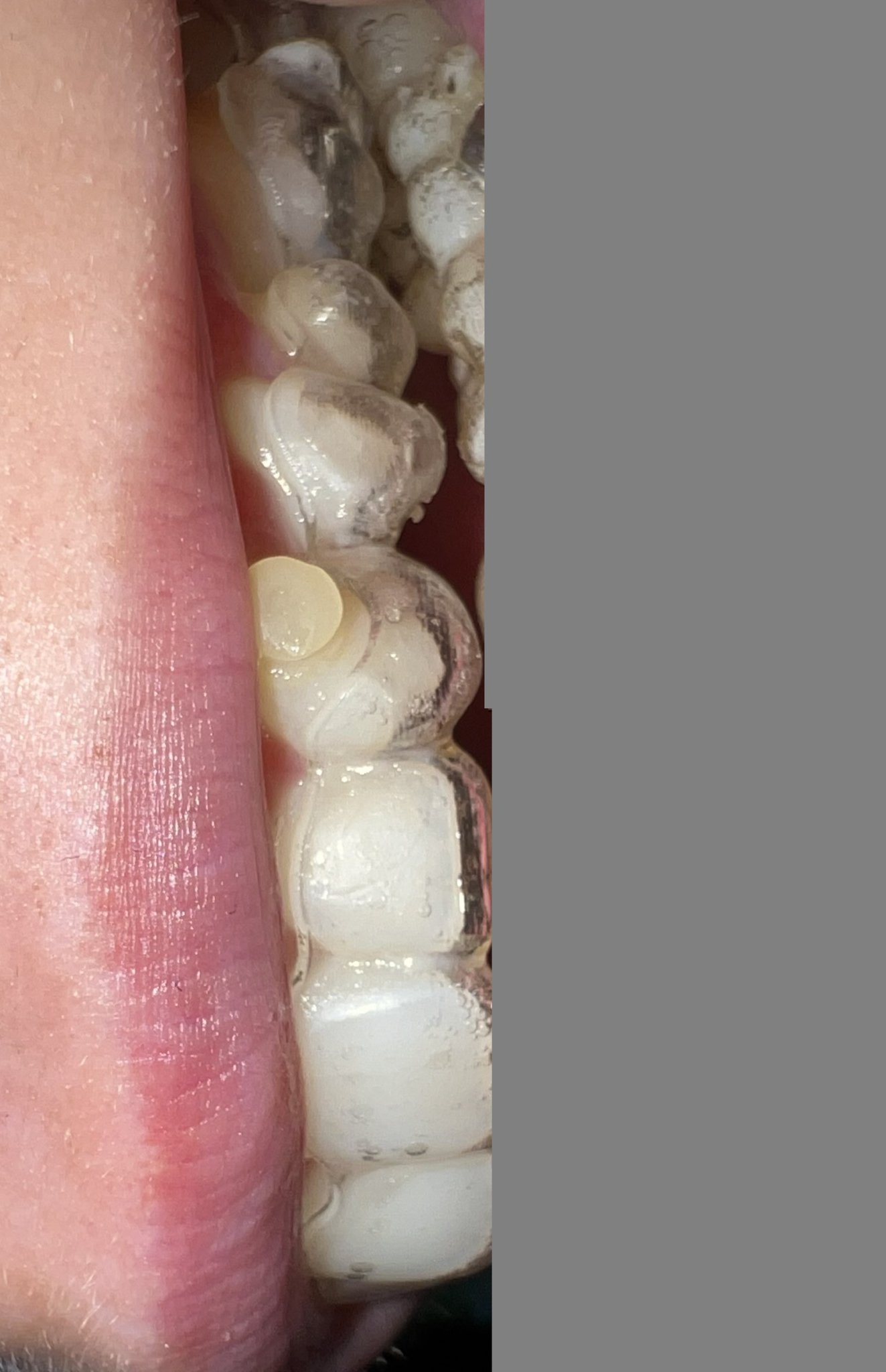Invisalign, Luft zwischen Schiene und Zahn