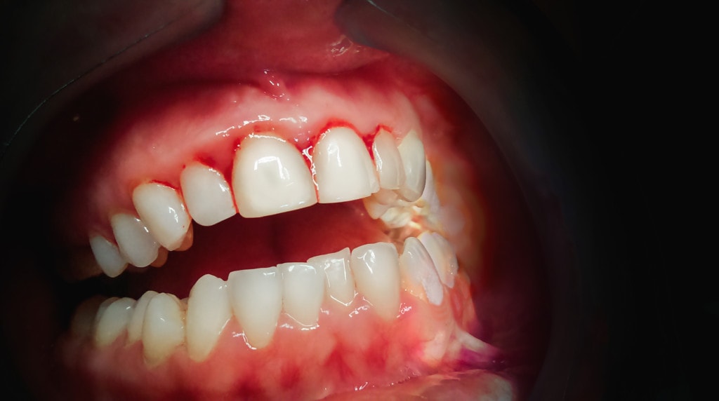 Zahnfleischentzündung, dunkles Zahnfleisch
