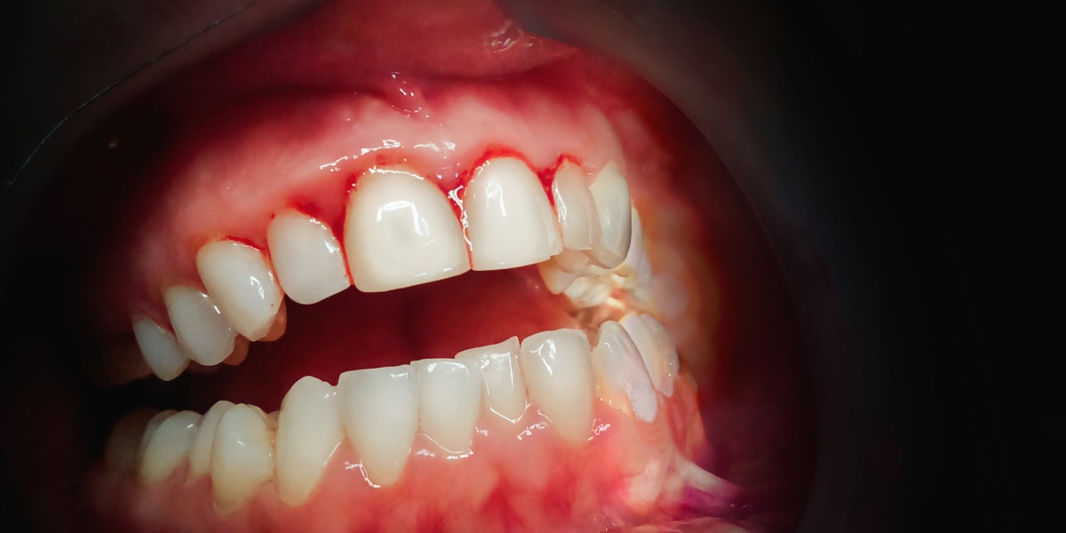 Zahnfleischentzündung, dunkles Zahnfleisch