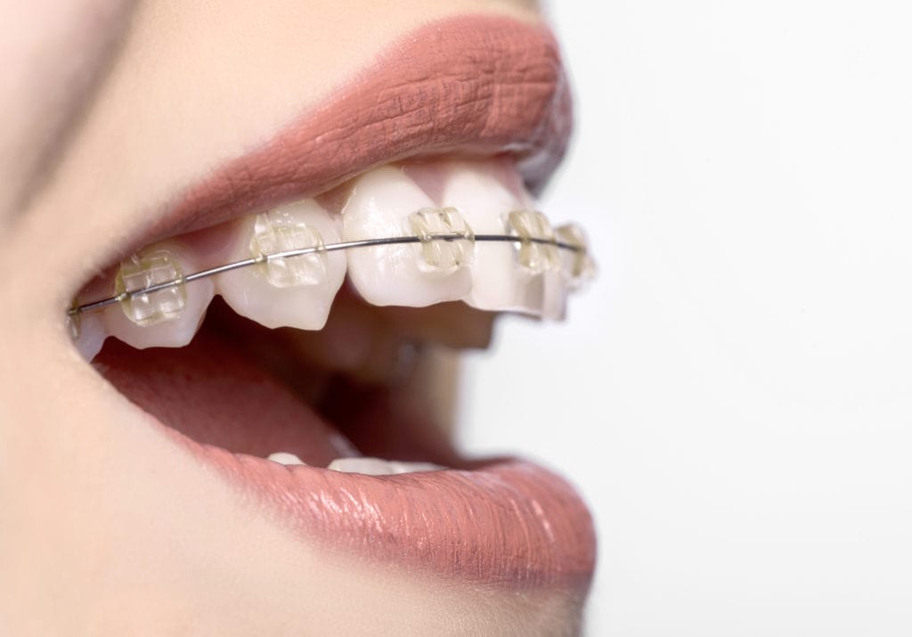 Nahaufname Zahnspange an Zähnen einer Frau