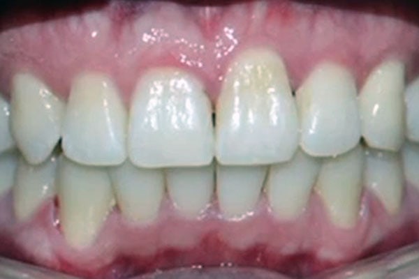 Frontalansicht Gebiss nach der Behandlung mit Zahnspangen