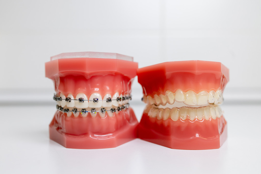 Vergleich feste Spange Invisalign, feste Zahnspange Erwachsene