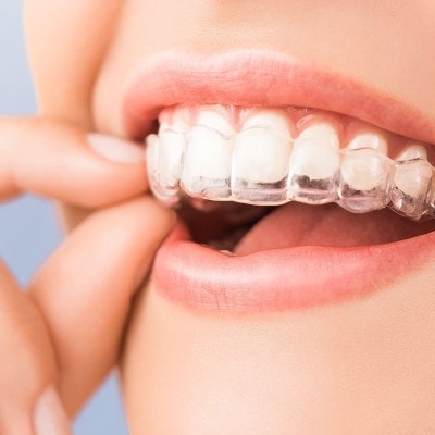 Wann Zahnschiene erneuern?