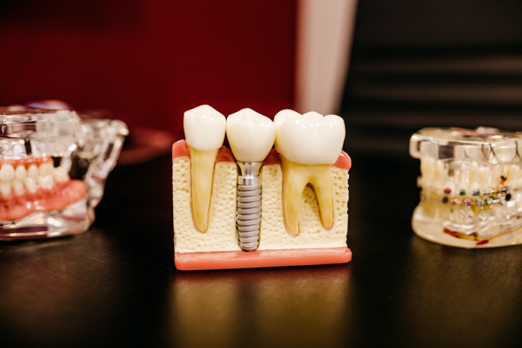 Implantat vs Zahnbrücke