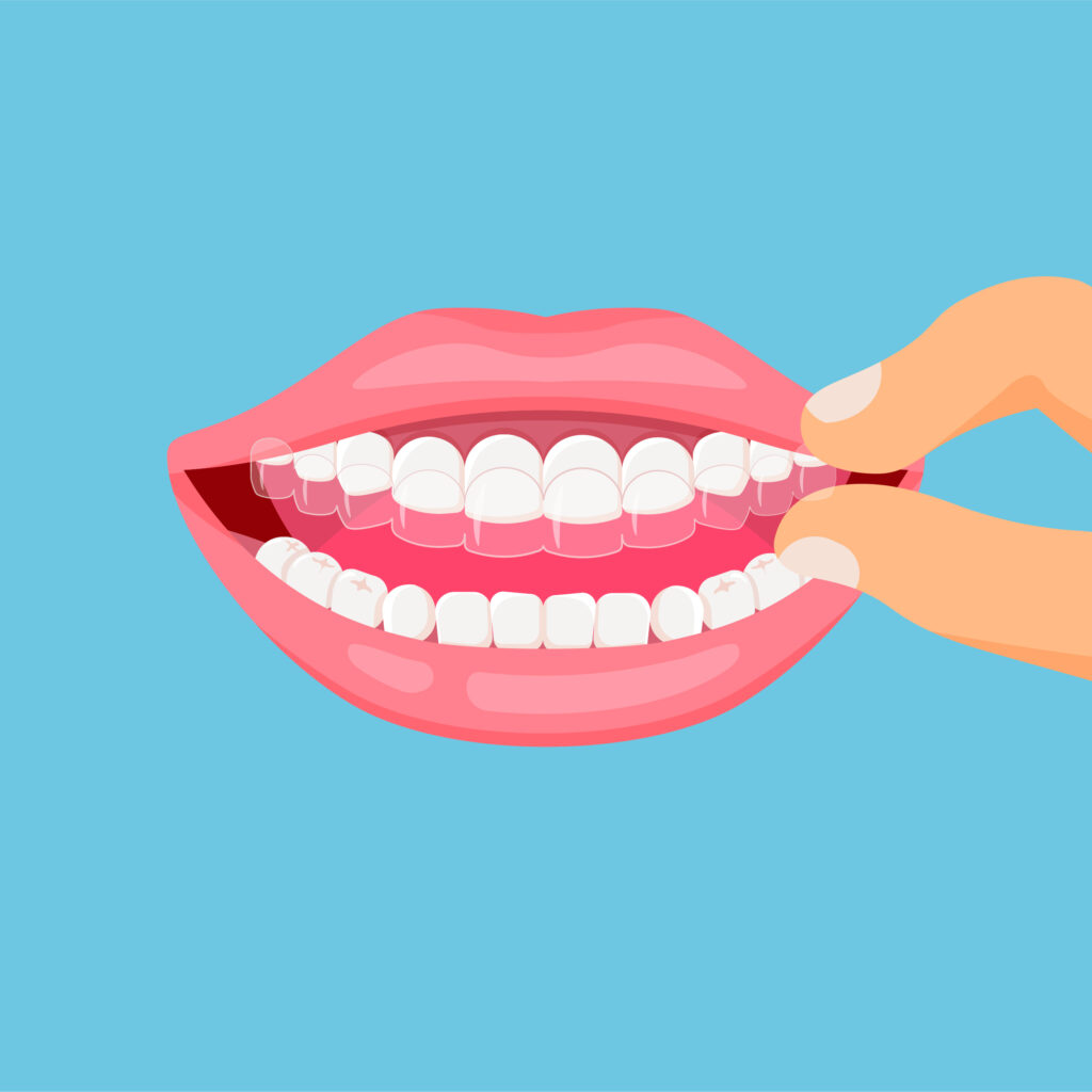 Aligner: Zahnschienen für Erwachsene