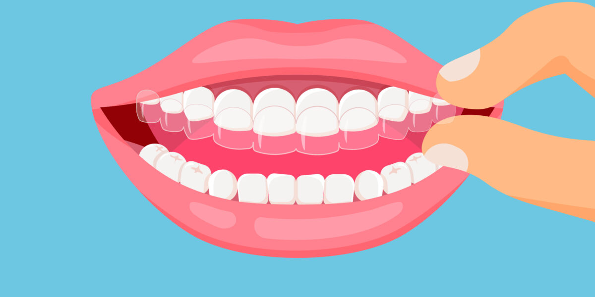 Invisalign Therapie, Zahnschiene