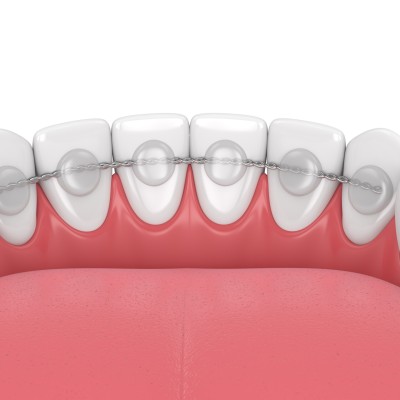Retainer Zähne: Die 10 wichtigsten Tipps mit Vor- und Nachteilen, Kosten und Materialien