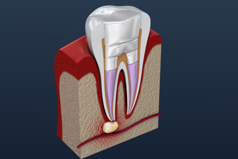 Zahn mit Wurzelfüllung