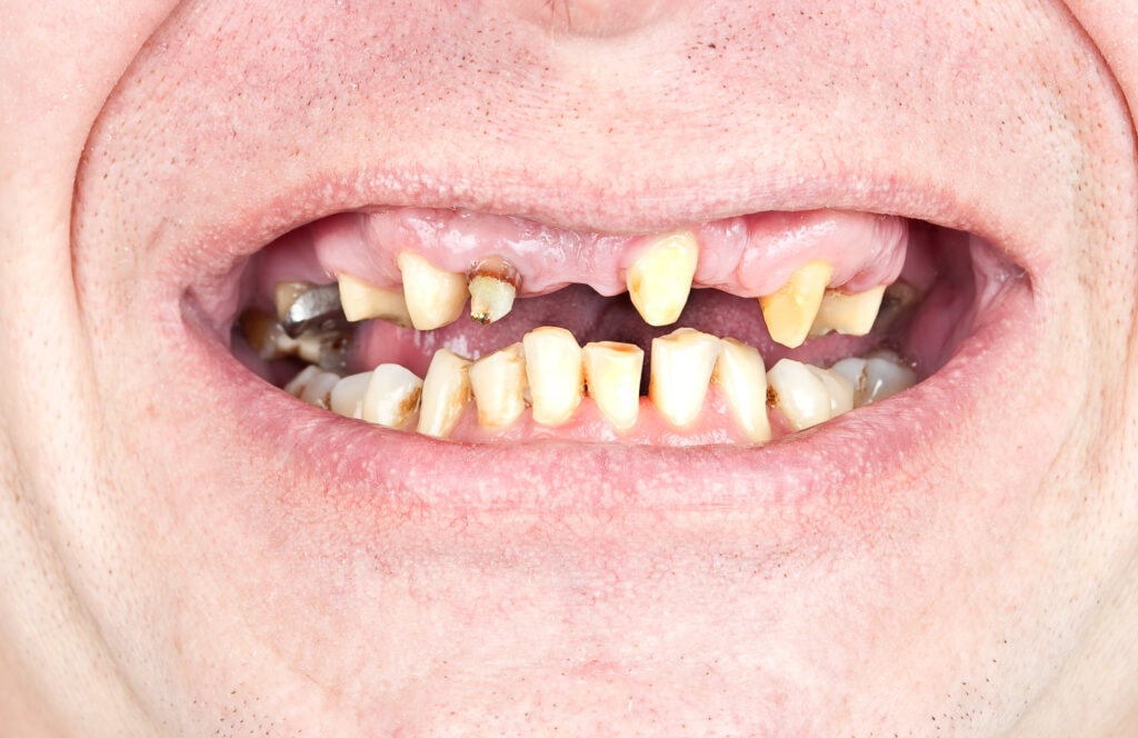 schlechte Zähne