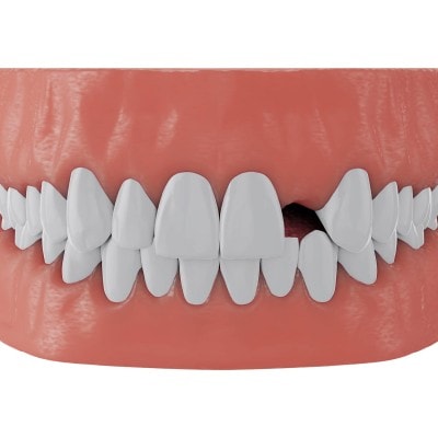 Nichtanlage von Zähnen