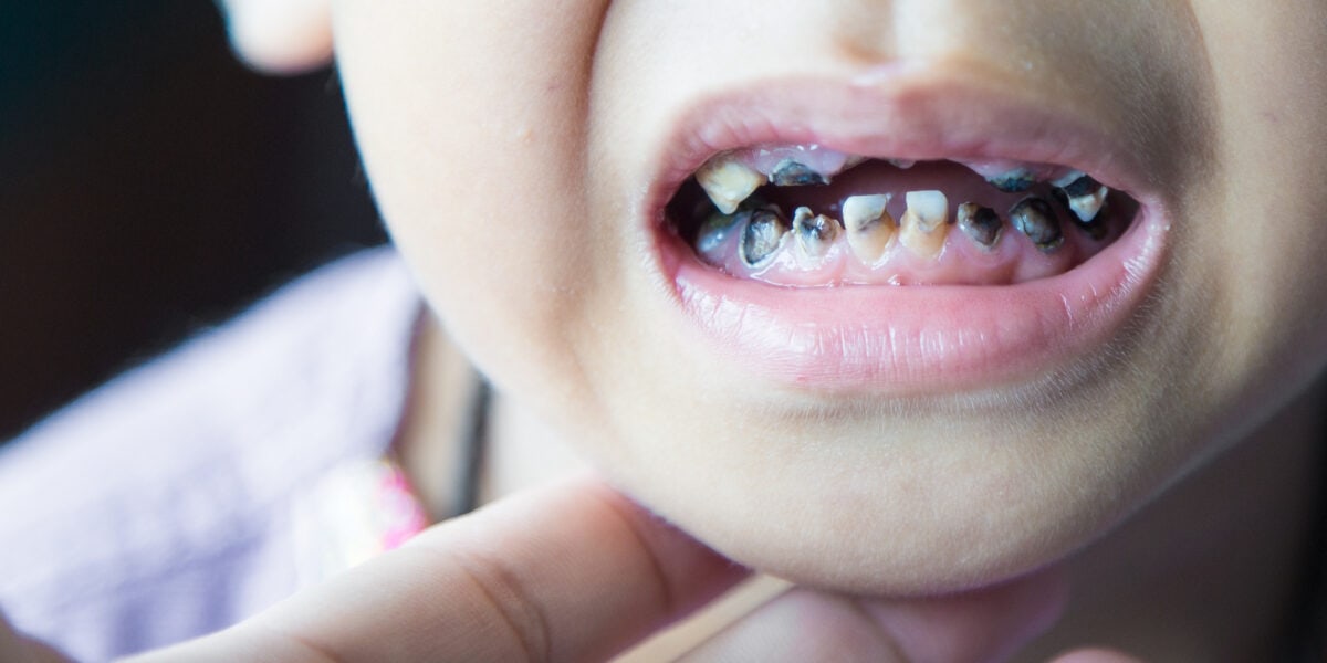 schlechte Zähne bei Kindern