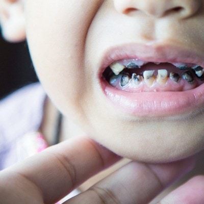Schlechte Zähne Kinder