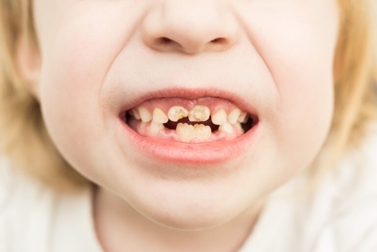 schlechte Zähne Kinder