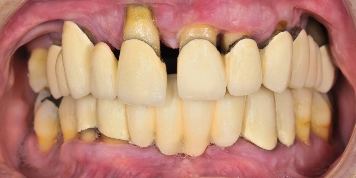 schlechte Zähne mit 50