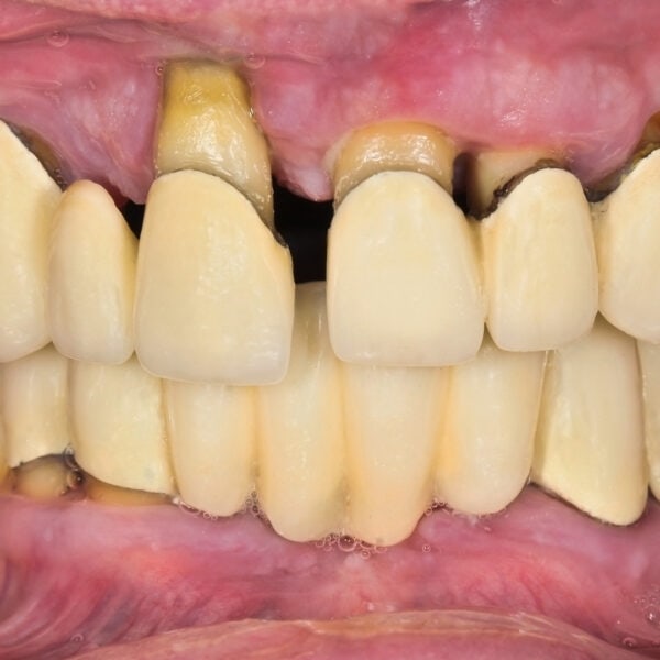 schlechte Zähne mit 50