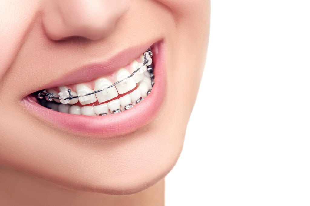 Speed Brackets, Zähne korrigieren, feste Zahnspange Erwachsene