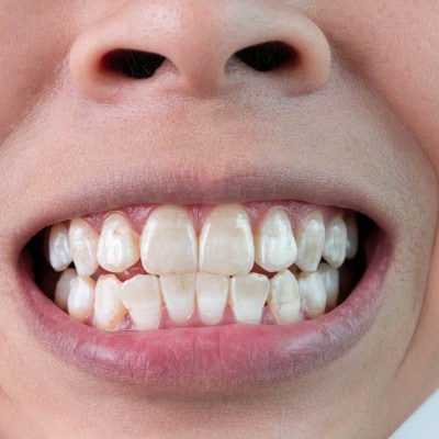 Weiße Flecken auf den Zähnen?