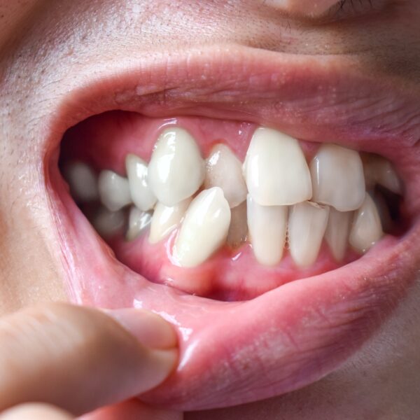 schiefe Zähne schlimm