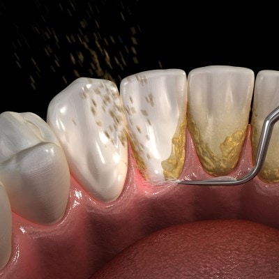 Zahnstein und Zahnspangen