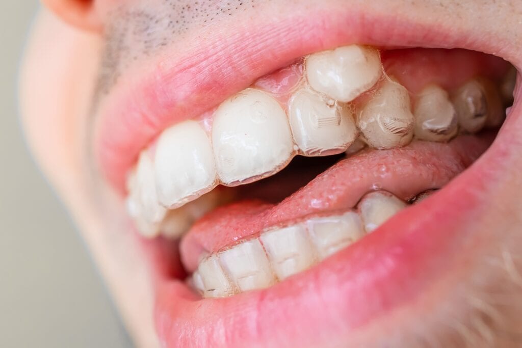 Unterschied zwischen Invisalign drsmile, invisible Zahnschienen