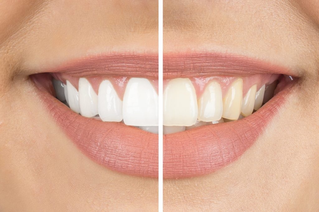 Bleaching, Weißmacher Zähne - kosmetische Zahnmedizin 