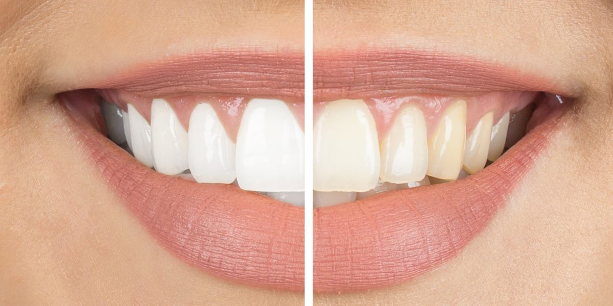 Bleaching, Weißmacher Zähne - kosmetische Zahnmedizin bei Dr. Krause in Schäftlarn