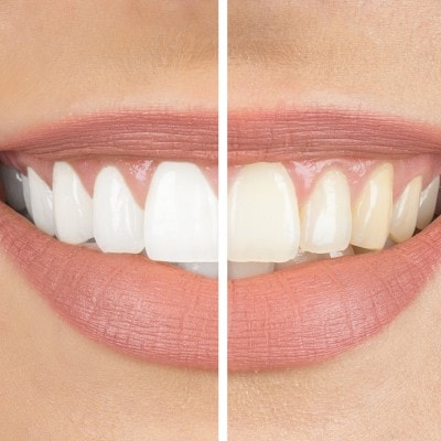 Weißmacher Zähne