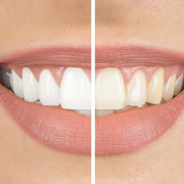 Bleaching, Weißmacher Zähne - kosmetische Zahnmedizin bei Dr. Krause in Schäftlarn