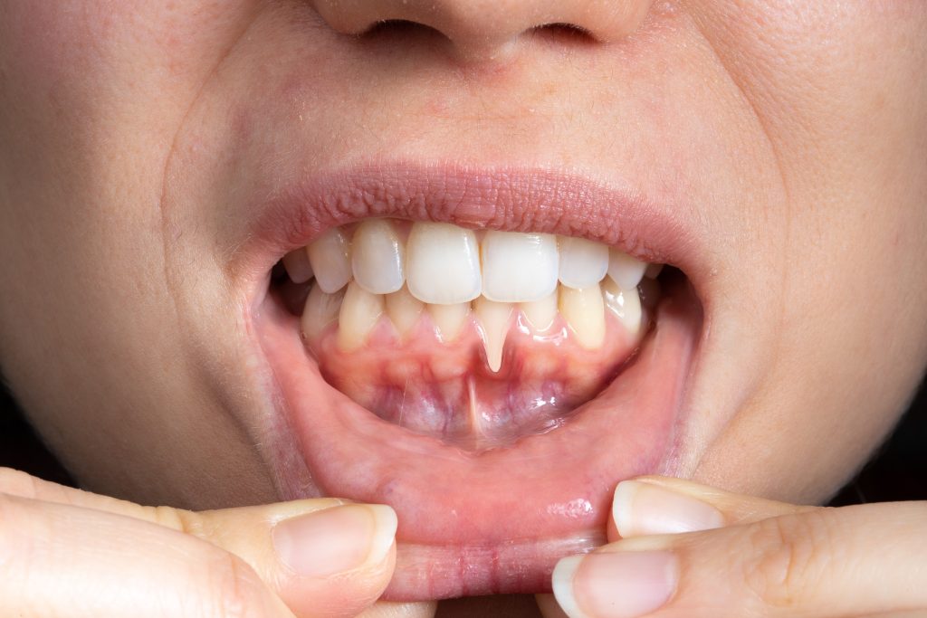 Zahnfleischrückgang, Engstand Zähne