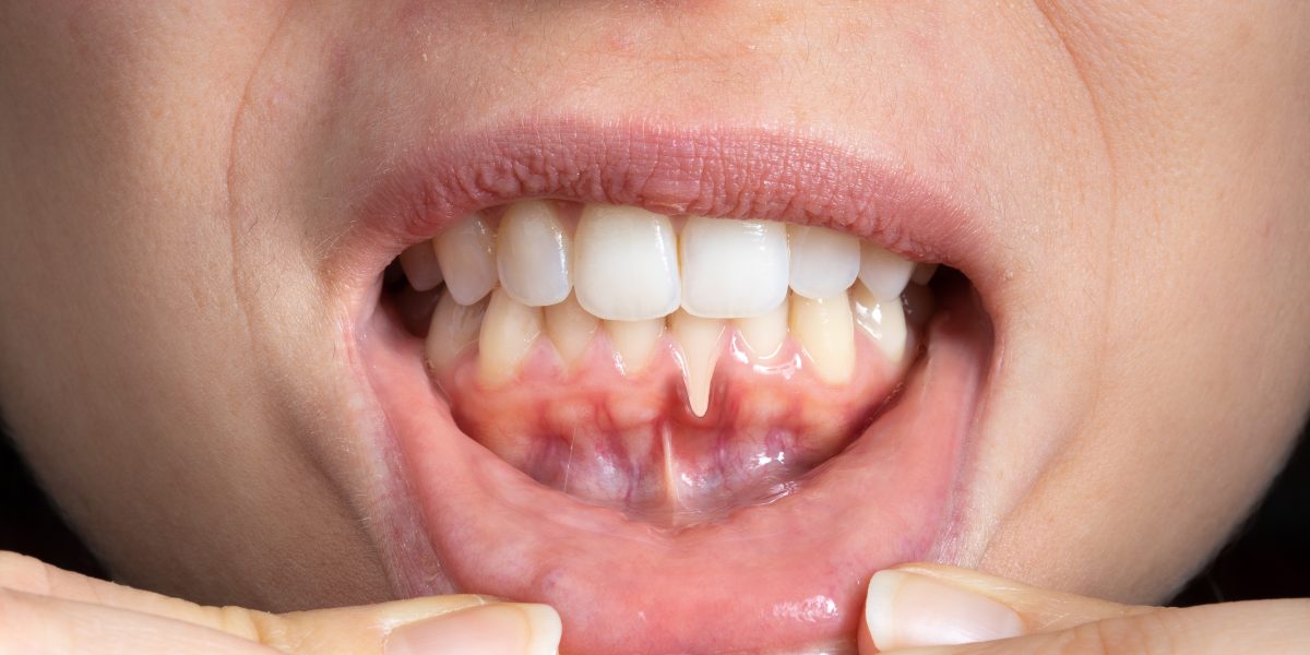Zahnfleischrückgang, Engstand Zähne, freiliegende Zahnhälse