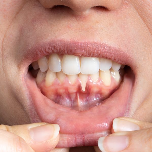 Zahnfleischrückgang, Engstand Zähne, freiliegende Zahnhälse