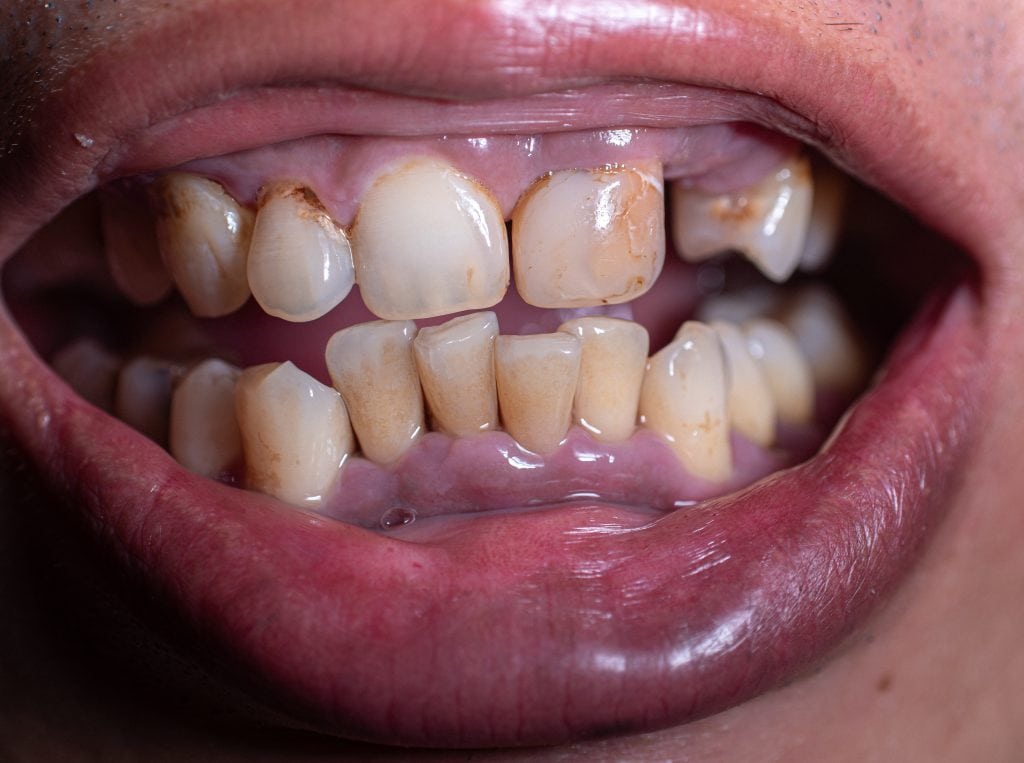 dunkles Zahnfleisch, Engstand Zähne