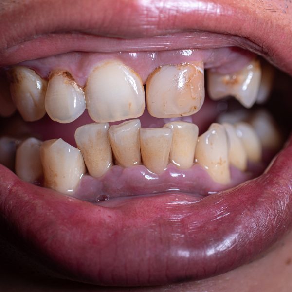 dunkles Zahnfleisch, Engstand Zähne