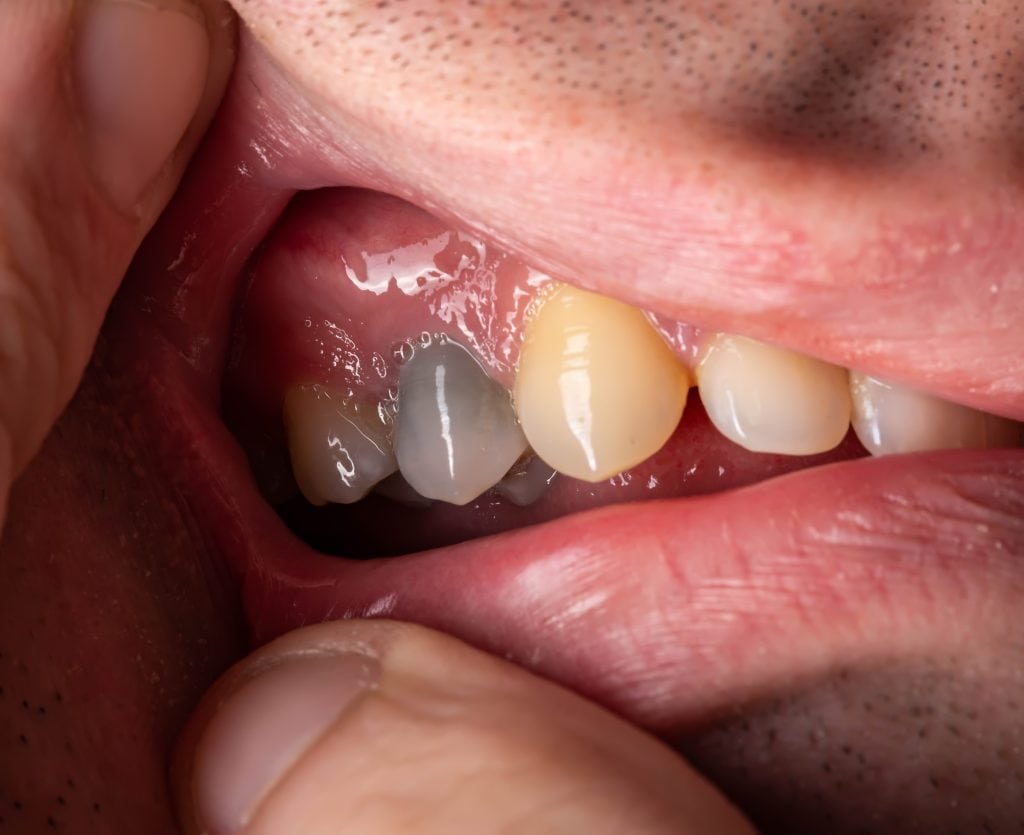 Zahnschmerzen nach Füllunf bei Zahnarzt