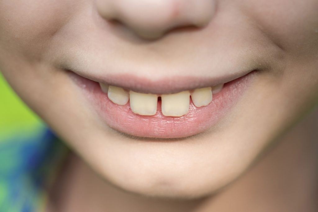 Zahn korrigieren - Überbiss