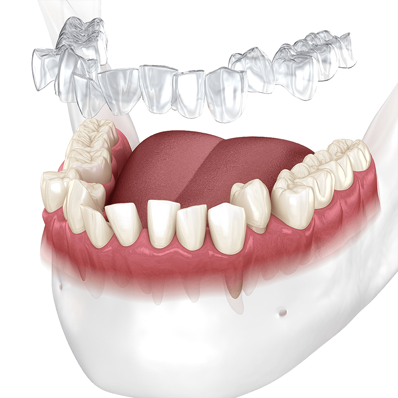Grafik: Zahnschiene vom Anbeiter ilovemysmile für schiefes Zähne am Unterkiefer