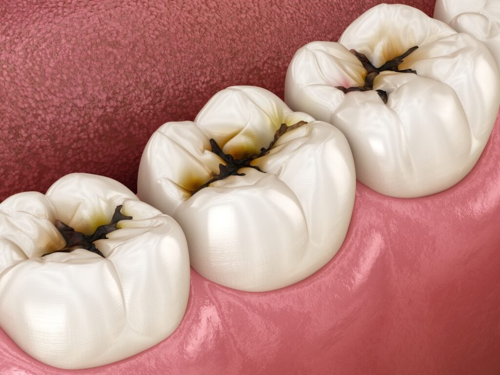Karies auf dem Zahn