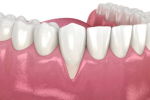 Invisalign Zahnfleischrückgang