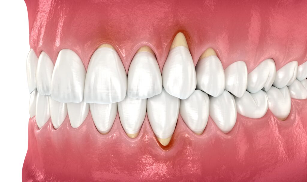 Invisalign Zahnfleischrückgang