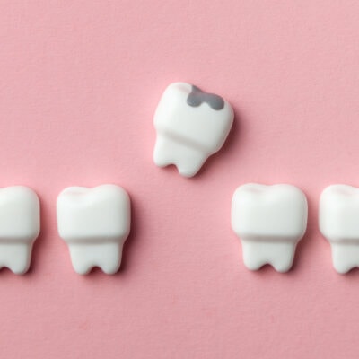 Zahnschmerzen nach einer Füllung beim Zahnarzt