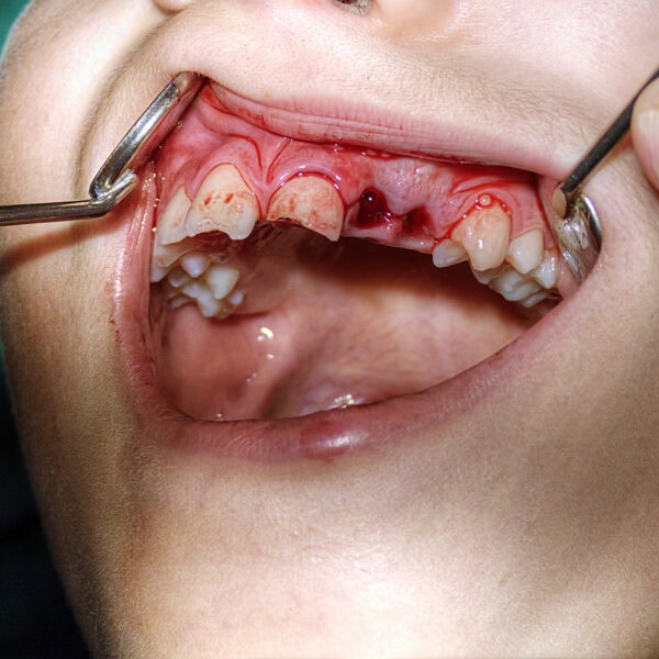 Zahnoperation
